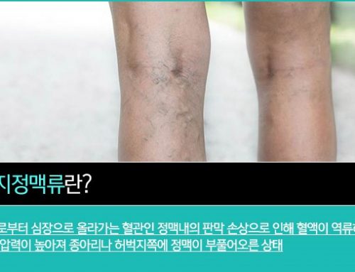 하지정맥류 치료비용 안내