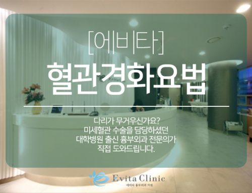 하지정맥류 – 혈관경화요법