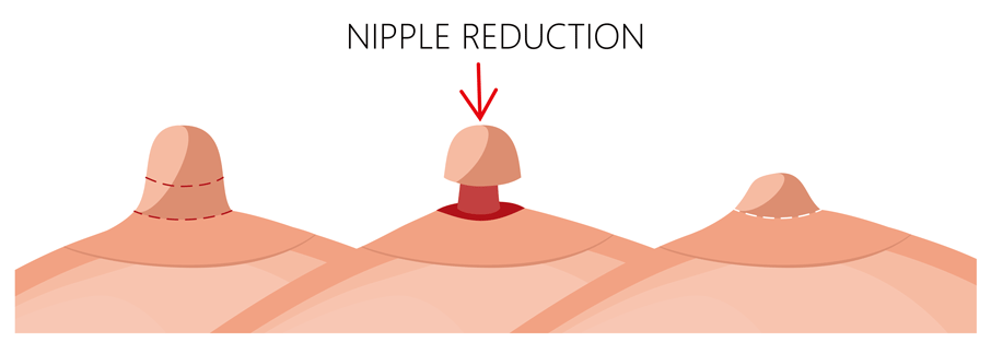 Nipple_Correction