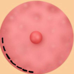 Semicricular_Incision-150×150