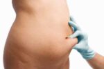liposuction_tummy_img_02 복부 지방흡입 – 에비타의원
